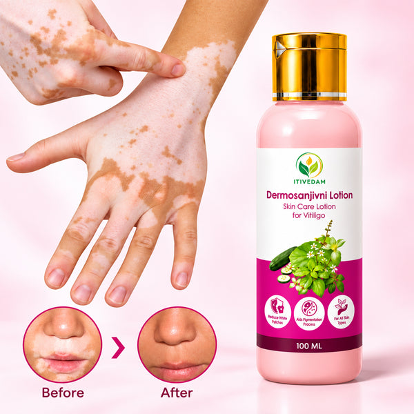 Itivedam Dermosanjivni Vitiligo Care Lotion
