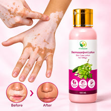 Itivedam Dermosanjivni Vitiligo Care Lotion